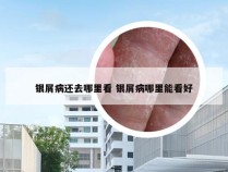 银屑病还去哪里看 银屑病哪里能看好