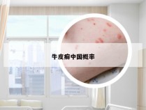牛皮癣中国概率