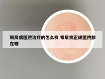 银屑病医院治疗的怎么样 银屑病正规医院都在哪