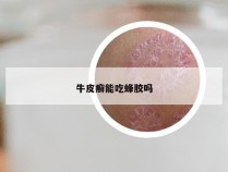 牛皮癣能吃蜂胶吗