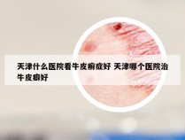 天津什么医院看牛皮癣症好 天津哪个医院治牛皮癖好
