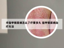 手指甲银屑病怎么了疗要多久 指甲银屑病治疗方法
