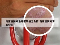 南京皮防所治疗银屑病怎么样 南京皮防所专家介绍