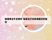 福建哪治牛皮癣好 福建治疗皮肤病最好的医院