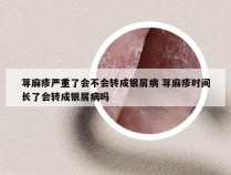 荨麻疹严重了会不会转成银屑病 荨麻疹时间长了会转成银屑病吗