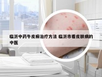 临沂中药牛皮癣治疗方法 临沂市看皮肤病的中医