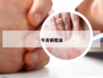 牛皮癣腊油