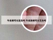 牛皮癣可以泥灸吗 牛皮肤癣可以艾灸吗