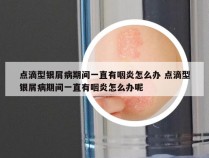 点滴型银屑病期间一直有咽炎怎么办 点滴型银屑病期间一直有咽炎怎么办呢