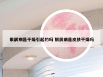 银屑病是干燥引起的吗 银屑病是皮肤干燥吗
