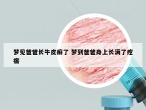 梦见爸爸长牛皮癣了 梦到爸爸身上长满了疙瘩