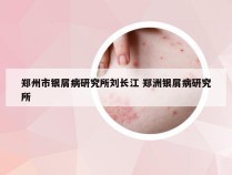 郑州市银屑病研究所刘长江 郑洲银屑病研究所
