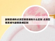 副银屑病和点滴型银屑病有什么区别 点滴型银屑病与副银屑病区别