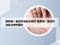 银屑病一直坚持治能去根吗 银屑病一直坚持治能去根吗图片