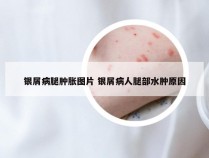 银屑病腿肿胀图片 银屑病人腿部水肿原因