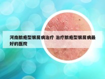 河南脓疱型银屑病治疗 治疗脓疱型银屑病最好的医院