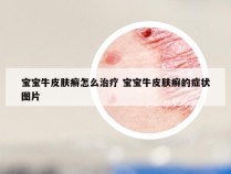 宝宝牛皮肤癣怎么治疗 宝宝牛皮肤癣的症状图片