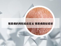 银屑病的同形反应定义 银屑病类似症状