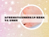 治疗银屑病关节炎生物制剂有几种 银屑病关节炎 生物制剂