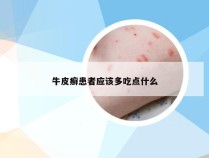 牛皮癣患者应该多吃点什么