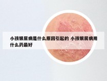 小孩银屑病是什么原因引起的 小孩银屑病用什么药最好