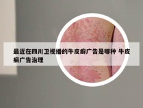 最近在四川卫视播的牛皮癣广告是哪种 牛皮癣广告治理
