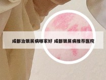 成都治银屑病哪家好 成都银屑病推荐医院