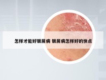 怎样才能好银屑病 银屑病怎样好的快点