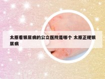 太原看银屑病的公立医院是哪个 太原正规银屑病