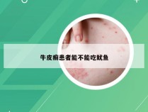 牛皮癣患者能不能吃鱿鱼