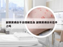 副银屑病会不会挠破出血 副银屑病会长在手上吗
