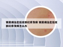 银屑病治愈后皮肤红疹发痒 银屑病治愈后皮肤红疹发痒怎么办
