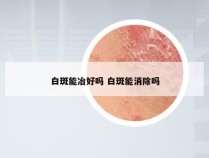白斑能冶好吗 白斑能消除吗