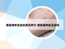 银屑病甲自愈的真实例子 银屑病甲能治愈吗