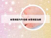 本草纲目与牛皮癣 本草纲目治癣
