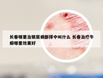 长春哪里治银屑病都择中叫什么 长春治疗牛癣哪里效果好