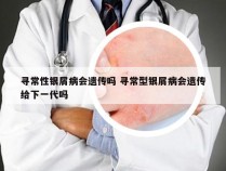 寻常性银屑病会遗传吗 寻常型银屑病会遗传给下一代吗