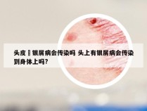 头皮廯银屑病会传染吗 头上有银屑病会传染到身体上吗?