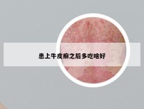患上牛皮癣之后多吃啥好