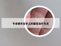 牛皮癣长在手上的最佳治疗方法