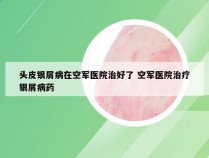 头皮银屑病在空军医院治好了 空军医院治疗银屑病药