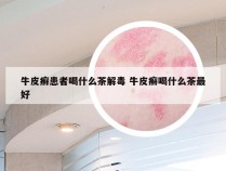 牛皮癣患者喝什么茶解毒 牛皮癣喝什么茶最好