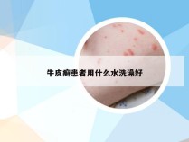 牛皮癣患者用什么水洗澡好
