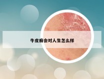 牛皮癣会对人生怎么样