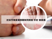 肘关节银屑病初期如何辨别 手肘 银屑病