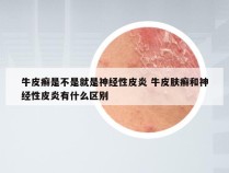 牛皮癣是不是就是神经性皮炎 牛皮肤癣和神经性皮炎有什么区别