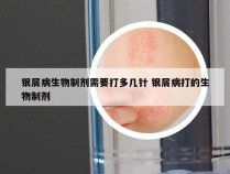 银屑病生物制剂需要打多几针 银屑病打的生物制剂