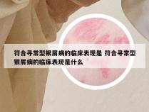 符合寻常型银屑病的临床表现是 符合寻常型银屑病的临床表现是什么