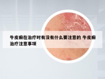 牛皮癣在治疗时有没有什么要注意的 牛皮癣治疗注意事项