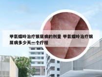 甲氨蝶呤治疗银屑病的剂量 甲氨蝶呤治疗银屑病多少天一个疗程